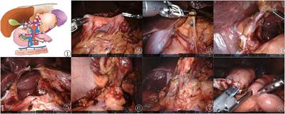 Robotic distal gastrectomy using a novel pre-emptive supra-pancreatic approach without duodenal transection in the dissection of D2 lymph nodes for gastric cancer